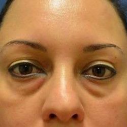 Blepharoplasty (Eyelid Surgery) Before & After Patient #13628