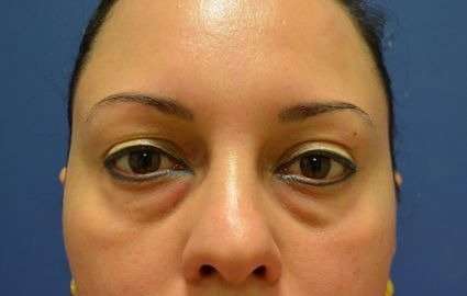 Blepharoplasty (Eyelid Surgery) Before & After Patient #13628