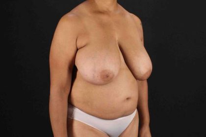 Breast Reconstruction Before & After Patient #10914