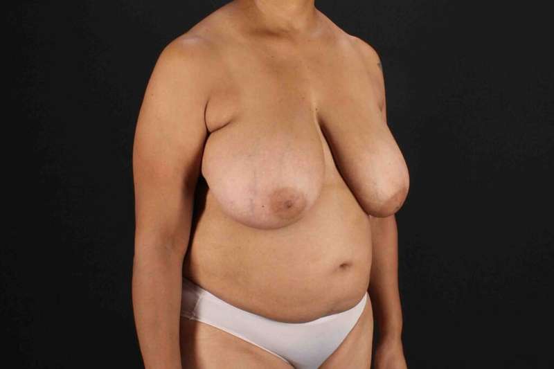 Breast Reconstruction Before & After Patient #10914