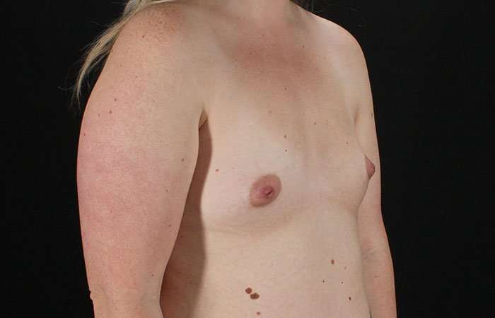 Breast Augmentation with Implants Before & After Patient #10870