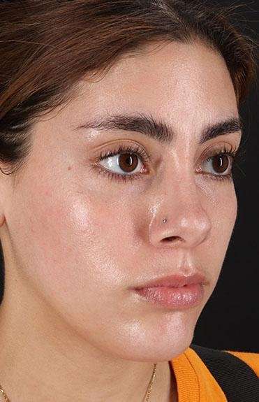 Fillers Before & After Patient #13287