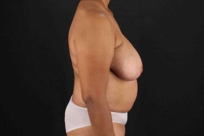 Breast Reconstruction Before & After Patient #10914
