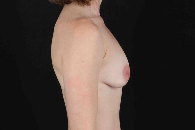 Breast Augmentation with Implants Before & After Patient #10892