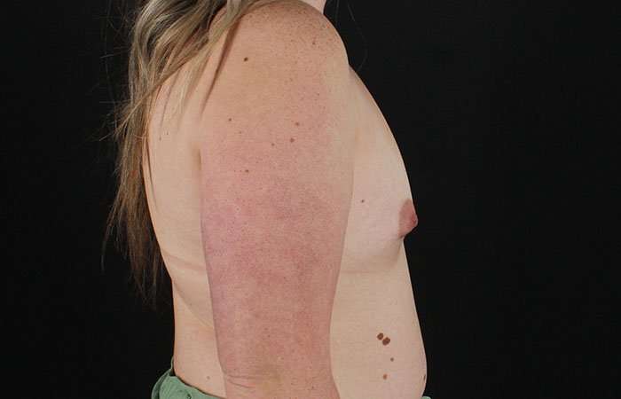 Breast Augmentation with Implants Before & After Patient #10870