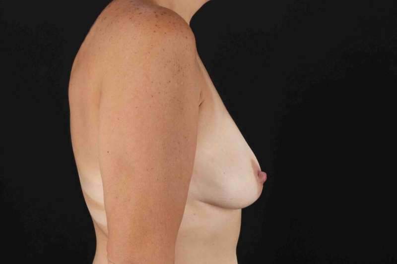 Breast Augmentation with Implants Before & After Patient #10881