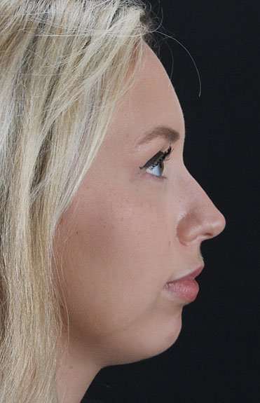 Fillers Before & After Patient #13309