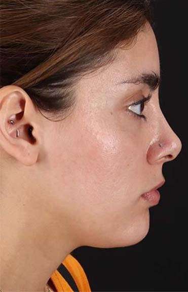 Fillers Before & After Patient #13287