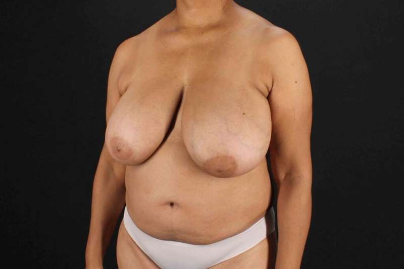 Breast Reconstruction Before & After Patient #10914