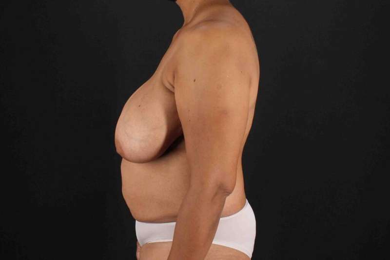 Breast Reconstruction Before & After Patient #10914