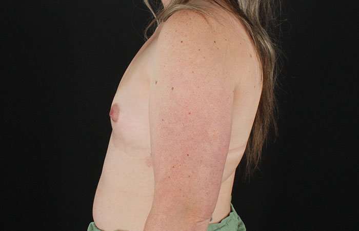 Breast Augmentation with Implants Before & After Patient #10870