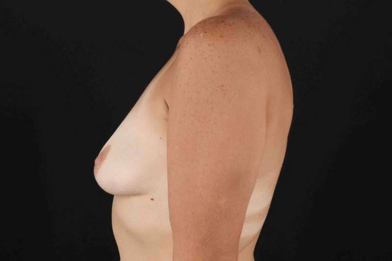 Breast Augmentation with Implants Before & After Patient #10881