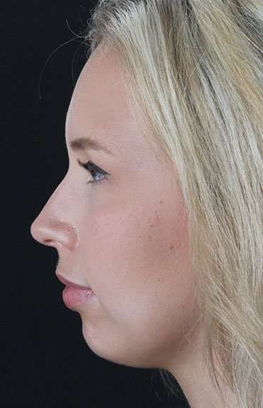 Fillers Before & After Patient #13309