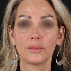 CO2 Laser Before & After Patient #11081