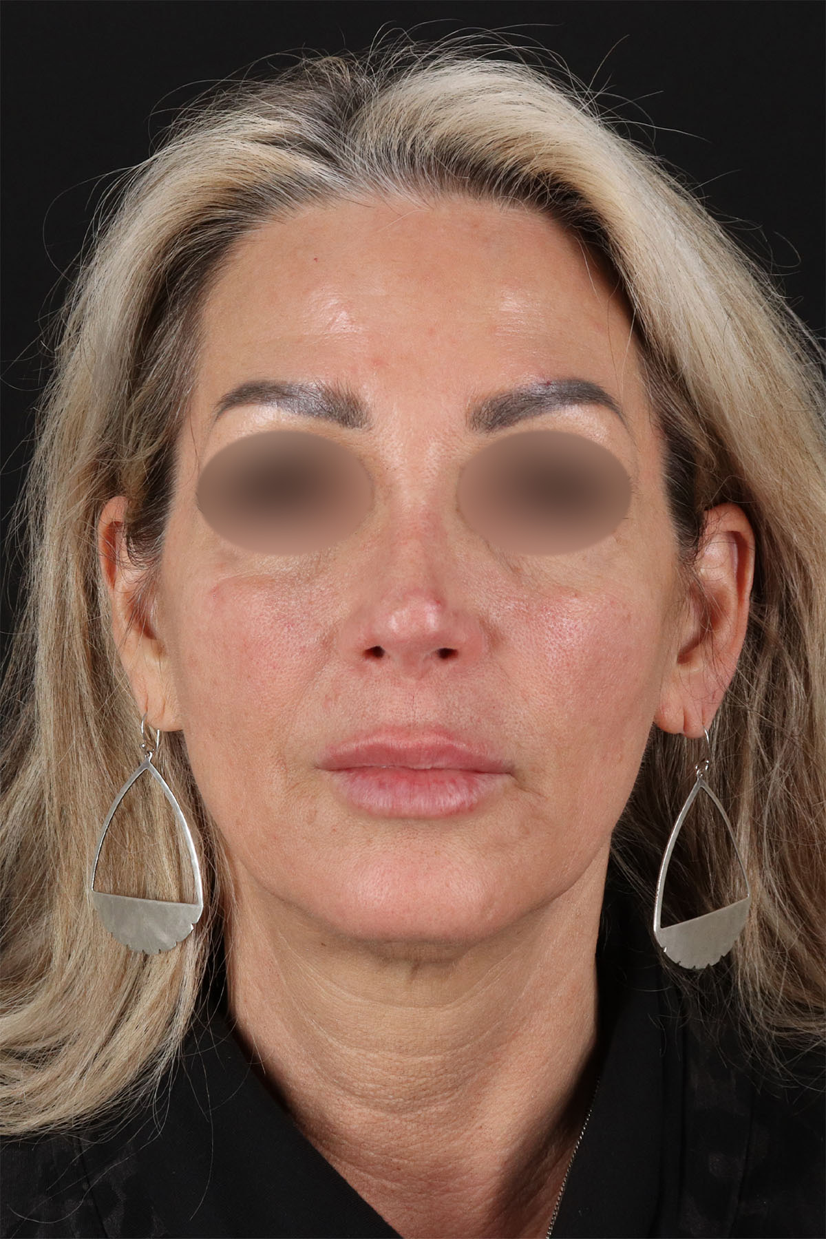 CO2 Laser Before & After Patient #11081