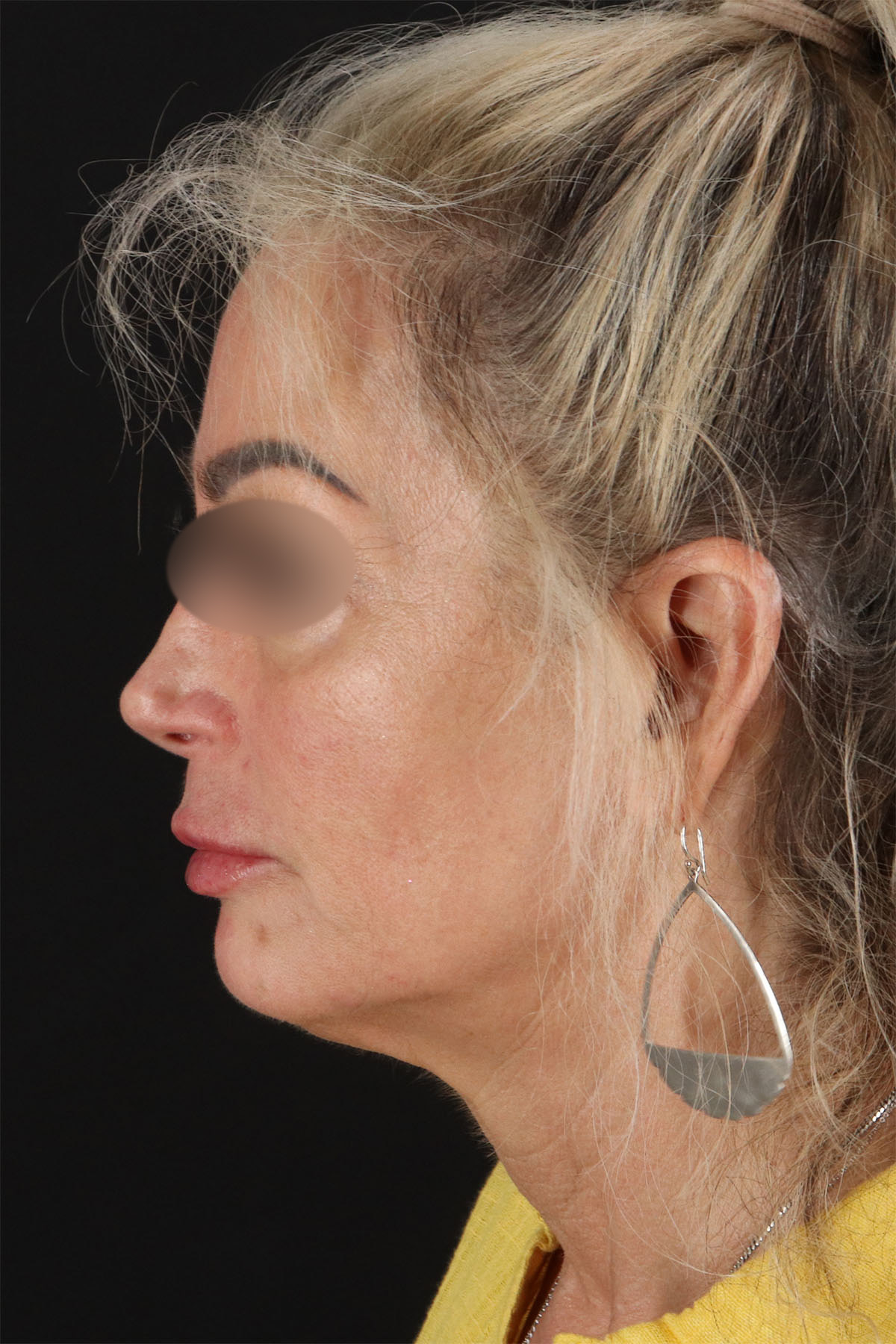 CO2 Laser Before & After Patient #11081