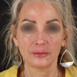 CO2 Laser Before & After Patient #11081