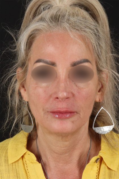 CO2 Laser Before & After Patient #11081