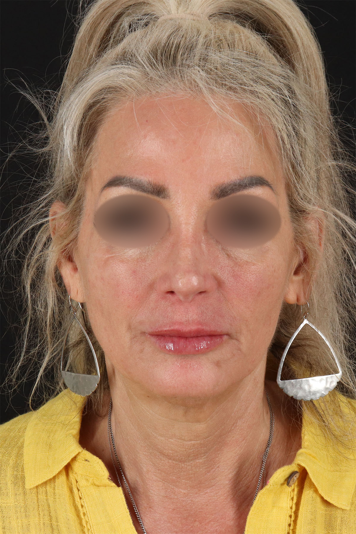 CO2 Laser Before & After Patient #11081