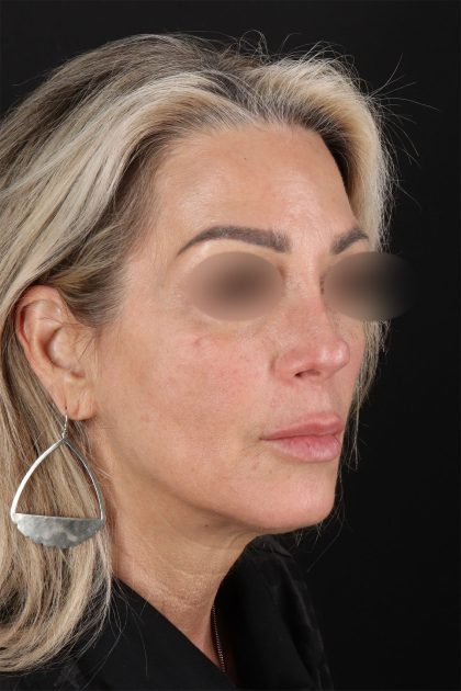 CO2 Laser Before & After Patient #11081