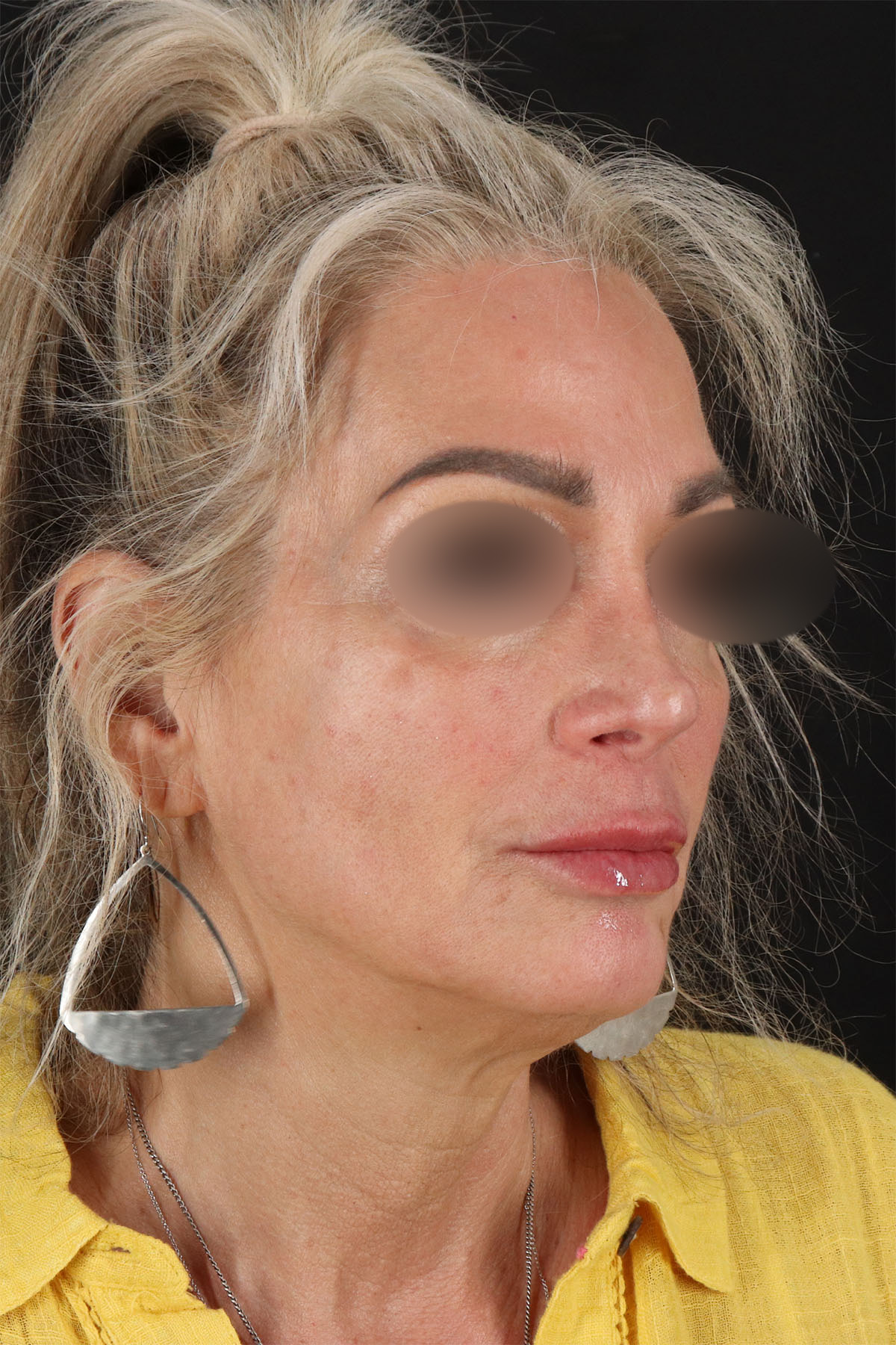 CO2 Laser Before & After Patient #11081