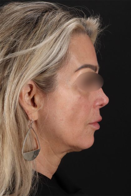 CO2 Laser Before & After Patient #11081