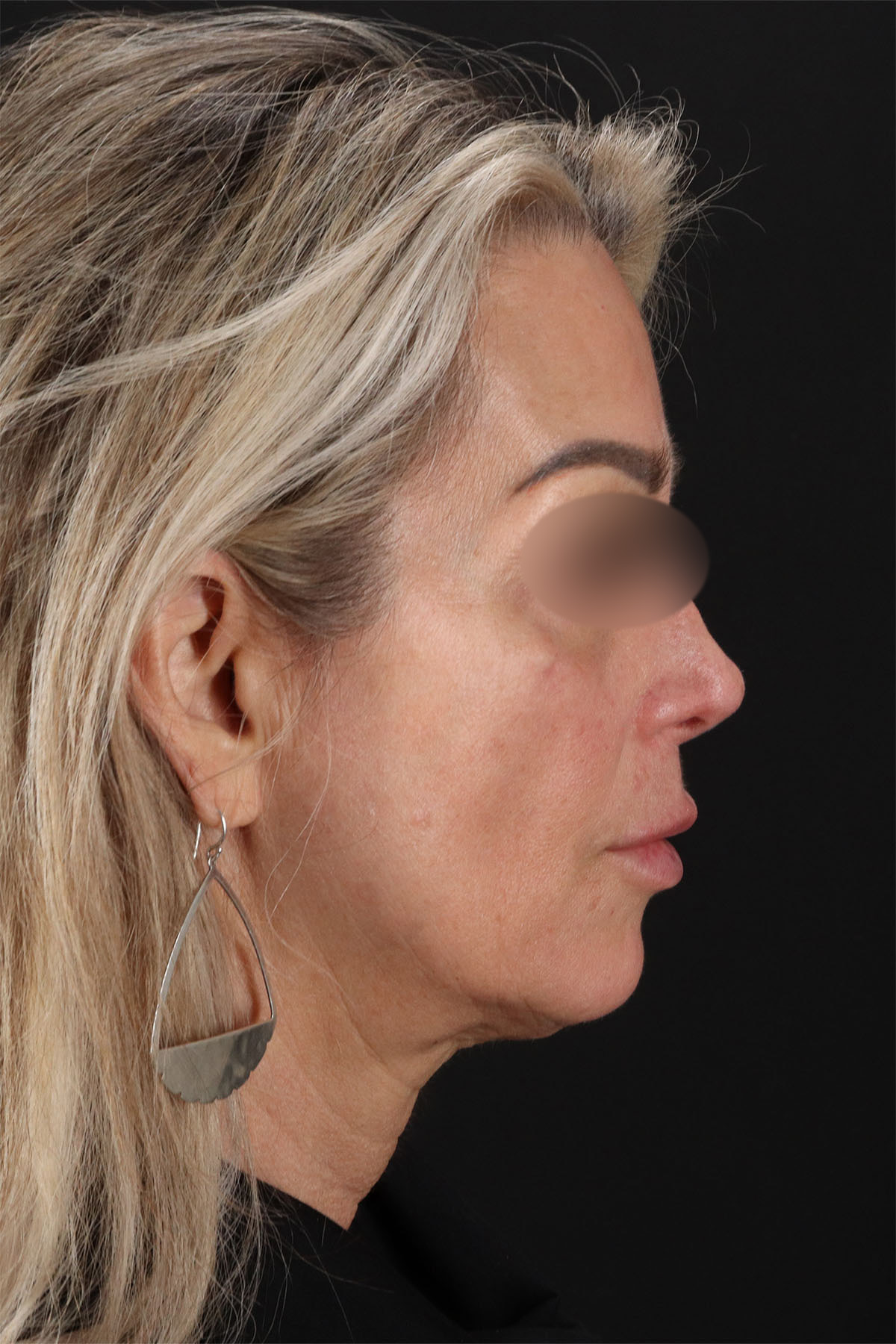 CO2 Laser Before & After Patient #11081
