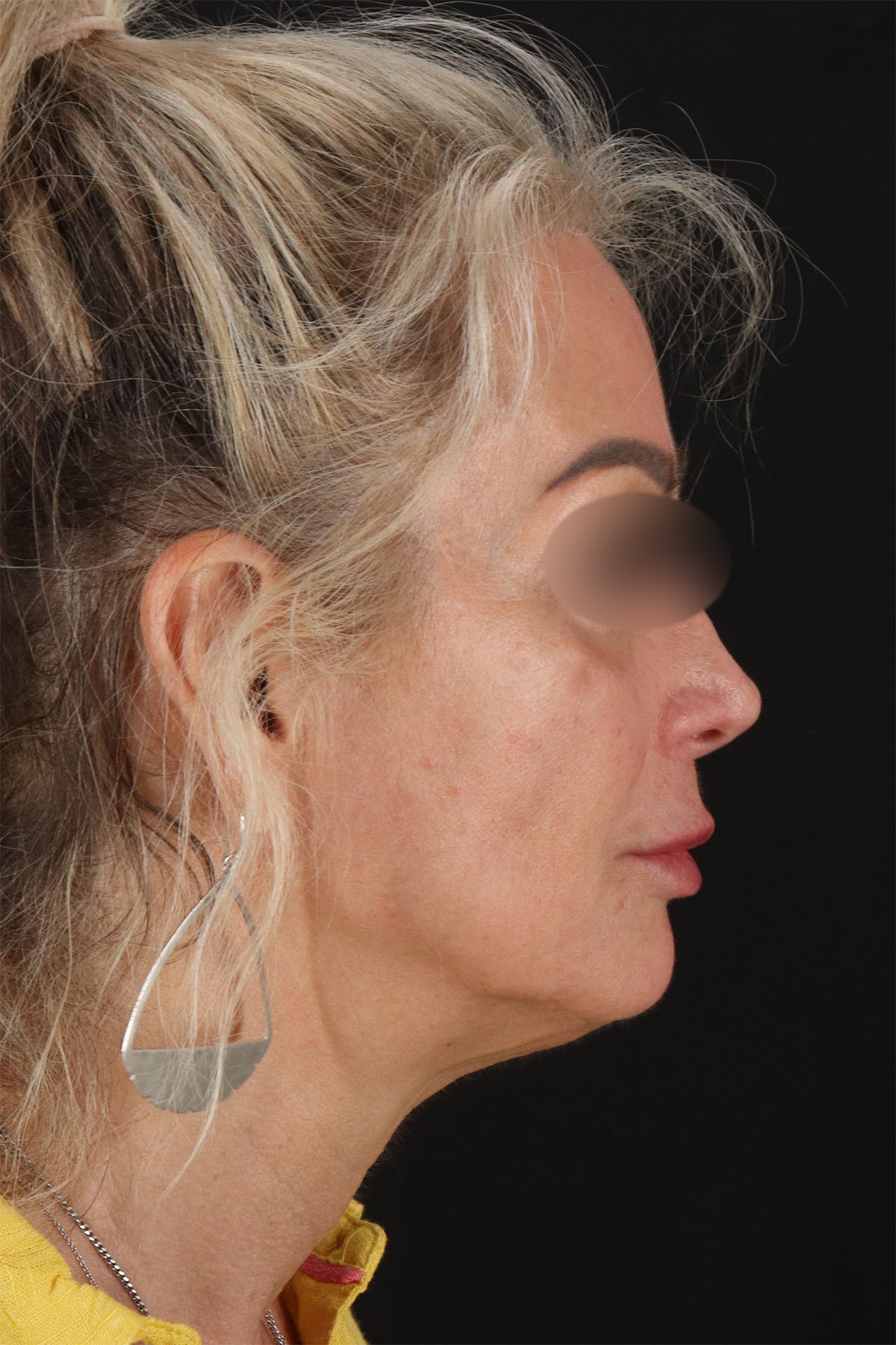 CO2 Laser Before & After Patient #11081