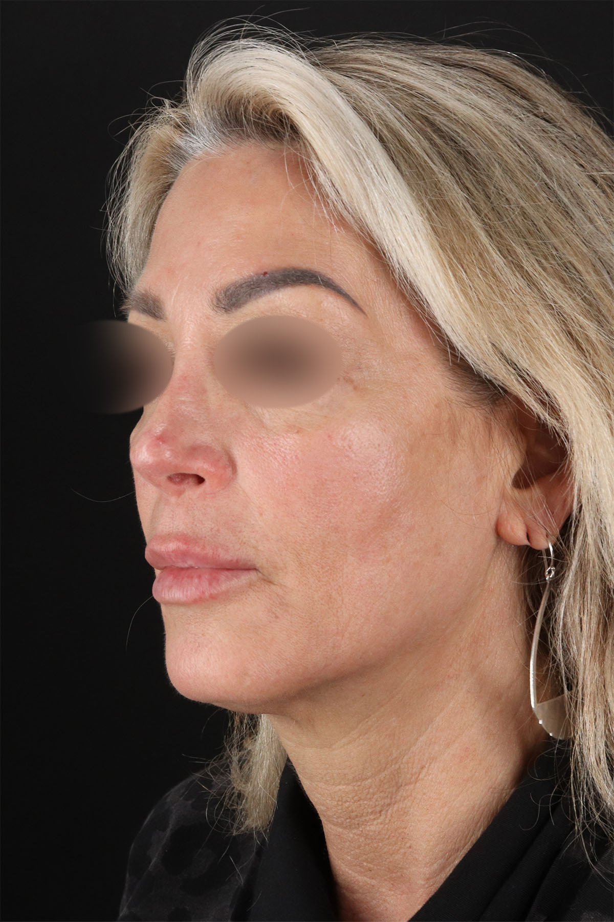 CO2 Laser Before & After Patient #11081