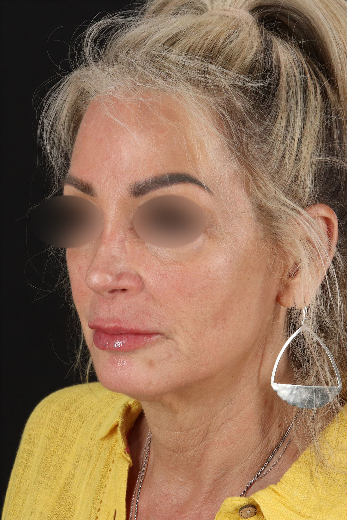 CO2 Laser Before & After Patient #11081