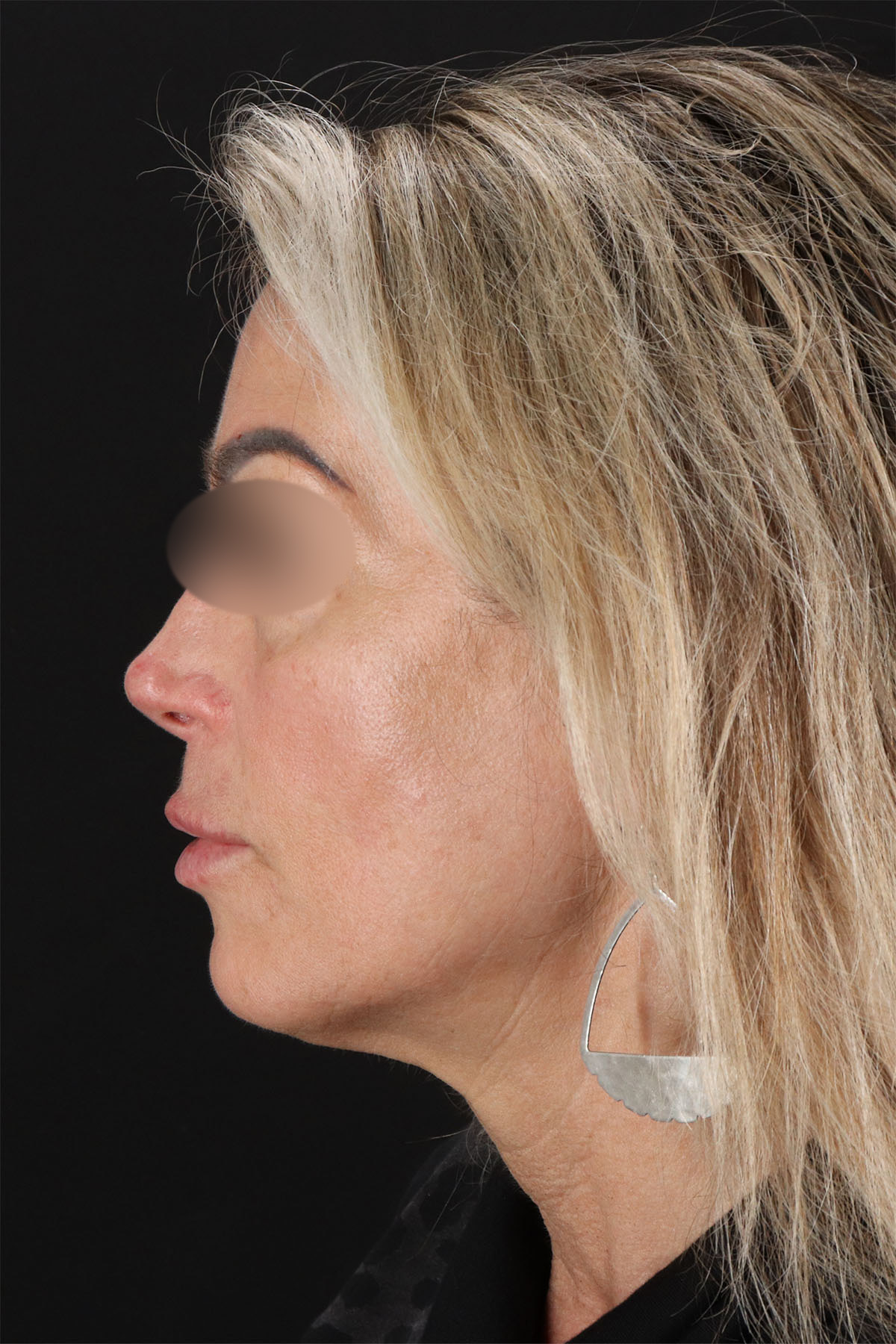 CO2 Laser Before & After Patient #11081
